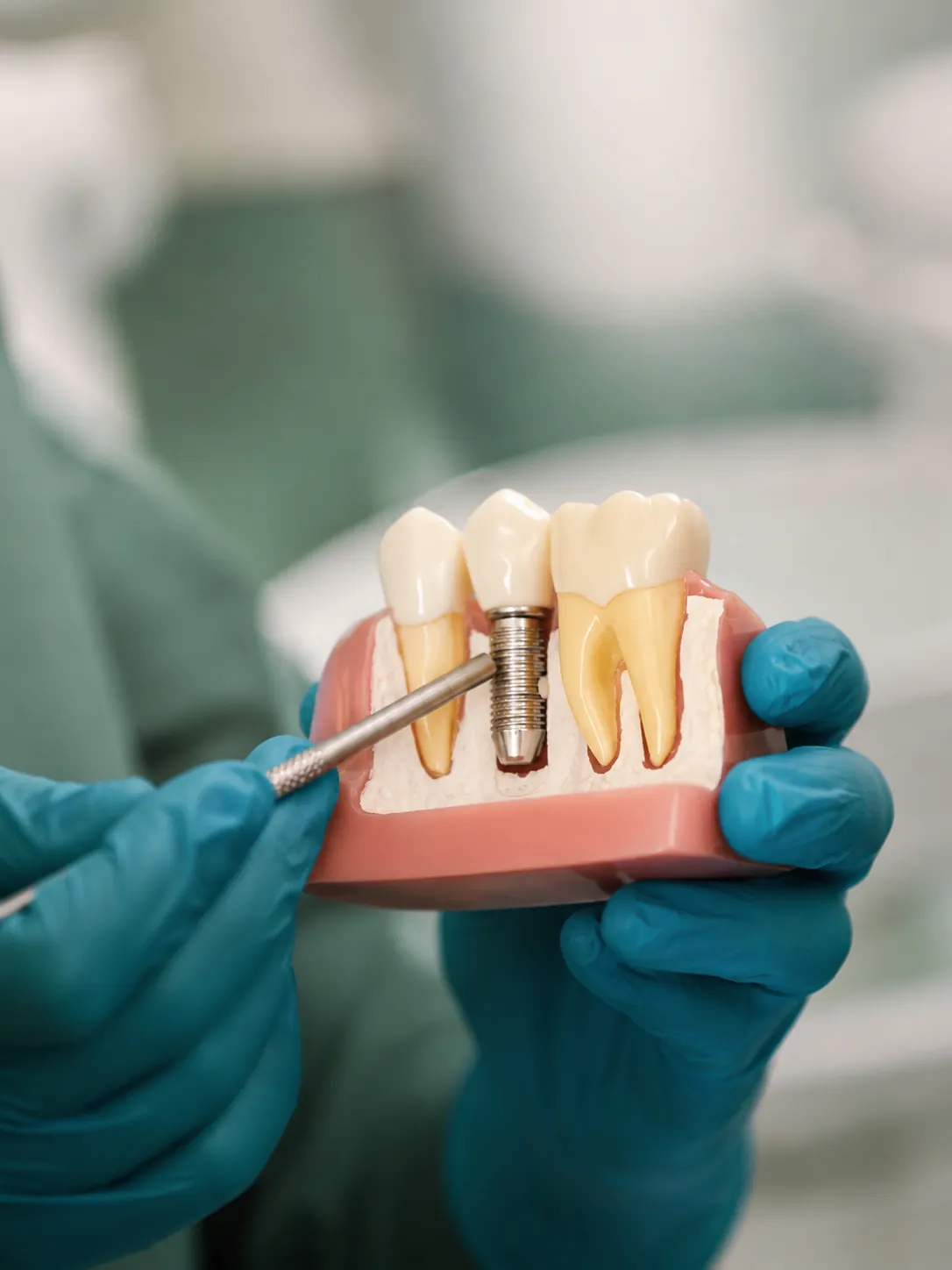 Atendimento de Implantodontia na Implantar